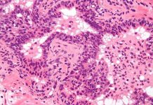 Almost All Men Produce Prostate Cancer Cells prostate